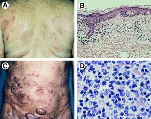 Fig. 1. Mycosis fungoides. (A) Patches and slightly infiltrated plaques. (B) Bandlike superficial infiltrate with marked infiltration of the epidermis (Hematoxylin & Eosin (H&E), original magnification × 50). (C) Tumor stage. (D) Tumor stage: detail of dermal infiltrate showing medium-sized to large lymphoid cells with hyperchromatic nuclei and blast cells (H&E, original magnification × 480).