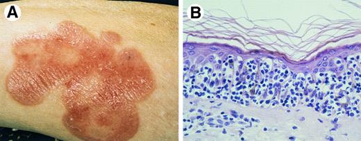 Fig. 2. Pagetoid reticulosis. (A) Clinical presentation with solitary plaque on lower leg. (B) Proliferation of atypical lymphoid cells within the epidermis (H&E, original magnification × 300).