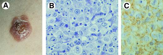 Fig. 3. Primary cutaneous CD30+ large T-cell lymphoma. (A) Clinical presentation with solitary tumor on the right arm. (B) Diffuse proliferation of large anaplastic cells with pleomorphic nuclei, prominent nucleoli, and abundant cytoplasm (H&E, original magnification × 480). (C) CD30 expression by anaplastic T cells.