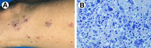 Fig. 4. Lymphomatoid papulosis. (A) Papulonecrotic lesions in various stages of evolution. (B) LyP type A: neutrophil-rich inflammatory infiltrate with scattered large atypical (multinucleated) cells. (H&E, original magnification × 480.)