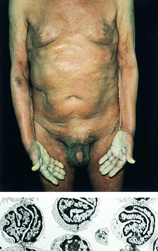 Fig. 5. Sézary's syndrome. (Top) Erythroderma. Note hyperkeratosis of the palms. Below: Electron micrograph showing characteristic Sézary cells in the peripheral blood (original magnification × 2,600).