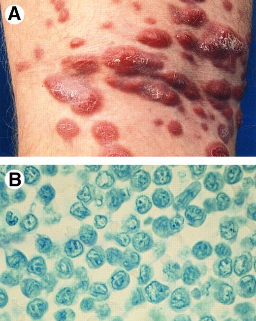Fig. 6. Primary cutaneous CD30− large T-cell lymphoma with (A) numerous tumorous plaques at presentation. (B) Detail of dermal infiltrate showing a monotonous proliferation of pleomorphic T cells with few admixed small T cells (Giemsa, original magnification × 600).