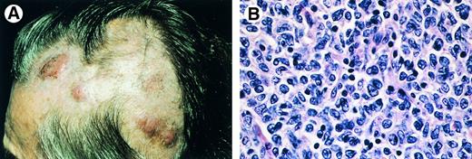 Fig. 7. Primary cutaneous follicle center cell lymphoma. (A) Characteristic clinical presentation with multiple nodules on the scalp. (B) Diffuse dermal infiltrate of (large) centrocytes and few centroblasts (H&E, original magnification × 480).