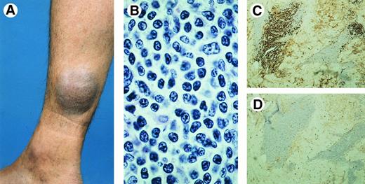 Fig. 8. Primary cutaneous immunocytoma (A) presenting with a deeply seated tumor on the right lower leg. (B) Diffuse dermal infiltrate of lymphocytes and lymphoplasmacytoid cells (H&E, original magnification × 750). (C-D) Monotypic lymphoplasmacytoid and plasma cells expressing lambda (C), but no kappa (D) immunoglobulin light chains.