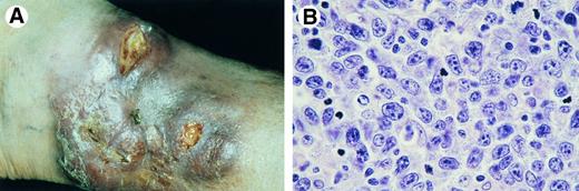 Fig. 9. Primary cutaneous large B-cell lymphoma of the leg. (A) Tumor mass confined to left lower leg at presentation. (B) Diffuse proliferation of centroblasts and some immunoblasts (H&E, original magnification × 750).