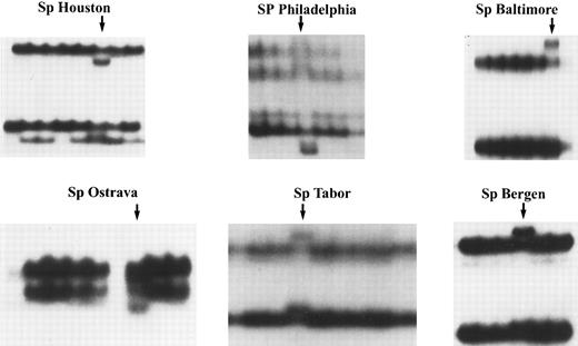 Fig. 1. Analysis of gDNA by SSCP. Genomic DNA was isolated from the peripheral blood mononuclear cells of patients and control subjects. The PCR was used to amplify individual exons of the β-spectrin gene for further analysis by SSCP. Shown are selected SSCP films pertaining to the exons of interest from the six patients who were ultimately found to have frameshift and nonsense mutations of the β-spectrin gene. Note the abnormal migration of additional bands in the patients (arrows), suggesting the presence of a mutation within one of the two alleles.