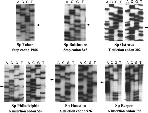 Fig. 2. Characterization of the β-spectrin mutations. Using the SSCP primers, and genomic DNA prepared from the patients' peripheral blood mononuclear cells, individual exons of interest were reamplified. The resulting DNA fragments were sequenced either by direct sequencing or by subcloning and sequencing of individual clones. Shown are the six frameshift and nonsense mutations of the β-spectrin gene. Note the base substitution in the cases of Sp Tabor and Sp Baltimore (nonsense mutations) reflected by the observation of two bands present at the same level by direct sequencing, as well as the base deletion or insertion (frameshift mutations) in the four other mutants seen by sequencing of individual clones.