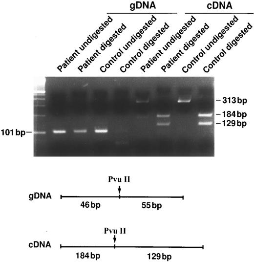 Fig. 3. Instability of the mutant mRNA. To address the stability of the mutant mRNA, we took advantage of the abrogation or creation of restriction sites by the point mutations. In this example (Sp Ostrava or 699delT), we took advantage of the PvuII restriction site abrogated by the mutation. Note the contrast between the heterozygous pattern of the genomic DNA and the homozygous pattern of the cDNA for the PvuII site in the patient's sample, suggesting the absence of one of the two transcriptional messages.