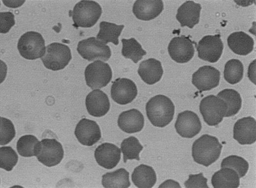 Fig. 5. Typical peripheral blood smear of patients with mutations of the β-spectrin gene. Note the conspicuous spherocytosis and the presence of frequent dense spiculated cells (acanthocytes).