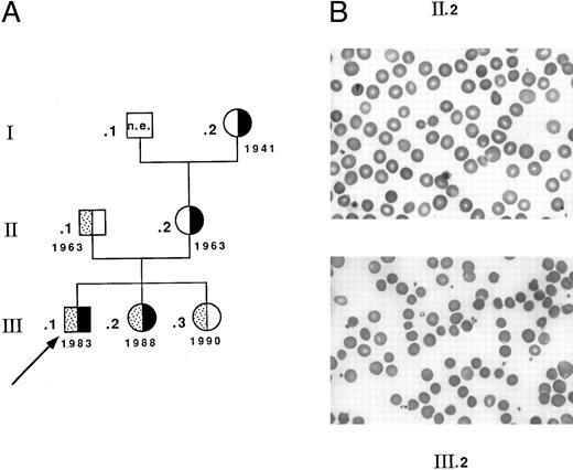 Fig. 1. Family MG. (A) Genealogic tree and birth dates: ▪, allele Coimbra; ▧ allele Mondego; ▧, proband. (B) Blood smears. Spherocytosis is more pronounced in child III.2 (and in child III.1, not shown) than in the mother II.2.