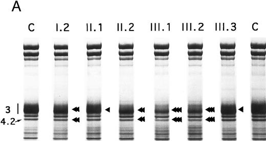 Fig. 2. SDS-PAGE of membrane proteins (A) and densitometric scanning (B) in members of family MG. C, controls. II.1 and III.3 (slight, ◂), I.2 and II.2 (moderate, ◂◂) and III.1 and III.2 (pronounced ◂◂◂), reductions of band 3 and protein 4.2.