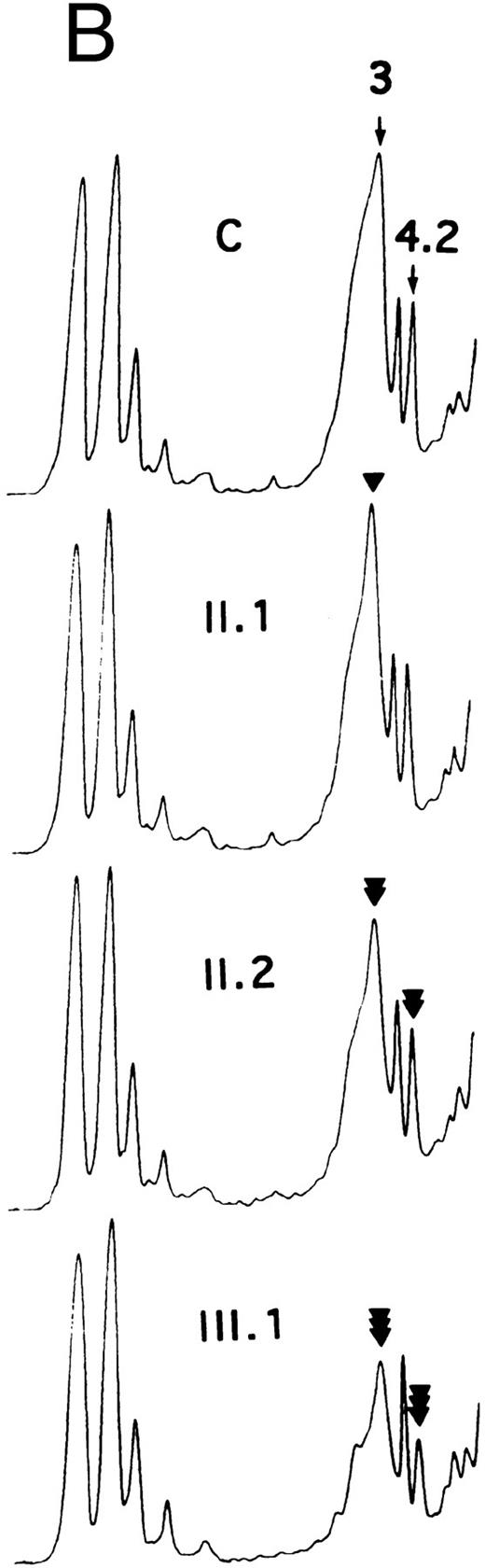 Fig. 2. SDS-PAGE of membrane proteins (A) and densitometric scanning (B) in members of family MG. C, controls. II.1 and III.3 (slight, ◂), I.2 and II.2 (moderate, ◂◂) and III.1 and III.2 (pronounced ◂◂◂), reductions of band 3 and protein 4.2.