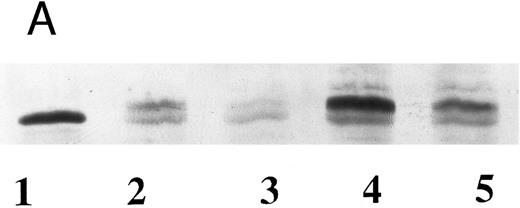 Fig. 4. Western blot analyses of wild-type and Gaucher disease acid β-glucosidase from recombinant (A) and natural (B) sources, using case 2 sera. (A) Immunoreactivity of recombinant wild-type and N370S enzymes expressed in the baculovirus system. Similar forms of both recombinant enzymes were detected with serum from case 2. Acid β-glucosidase (lane 1), wild-type enzyme (lanes 2 and 4), N370S enzyme (lanes 3 and 5). (B) Wild-type enzyme from an unaffected individual with normal levels of enzyme activity (lane 1), a Gaucher disease patient who was hemizygous for the N370S allele and a gene deletion (lane 2), the father of the patient in lane 2 who is hemizygous for the normal allele (lane 3), and case 2 who was heterozygous for N370S (lane 4). The three bands present in lanes 1, 3, and 4 correspond to different posttranslational glycosylation stages of acid β-glucosidase.