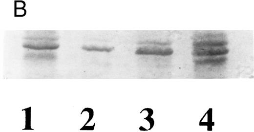 Fig. 4. Western blot analyses of wild-type and Gaucher disease acid β-glucosidase from recombinant (A) and natural (B) sources, using case 2 sera. (A) Immunoreactivity of recombinant wild-type and N370S enzymes expressed in the baculovirus system. Similar forms of both recombinant enzymes were detected with serum from case 2. Acid β-glucosidase (lane 1), wild-type enzyme (lanes 2 and 4), N370S enzyme (lanes 3 and 5). (B) Wild-type enzyme from an unaffected individual with normal levels of enzyme activity (lane 1), a Gaucher disease patient who was hemizygous for the N370S allele and a gene deletion (lane 2), the father of the patient in lane 2 who is hemizygous for the normal allele (lane 3), and case 2 who was heterozygous for N370S (lane 4). The three bands present in lanes 1, 3, and 4 correspond to different posttranslational glycosylation stages of acid β-glucosidase.