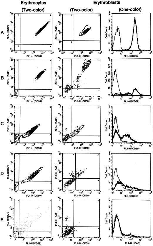 Fig. 1. Representative flow cytometric patterns of membrane CD59/MACIF and/or DAF expression by normal or PNH erythrocytes and erythroblasts. In 2-color analysis, 4 regions (shown by the lines) were set using the flow cytometric data of negative controls examined at the same time. Expression of CD59/MACIF and DAF by PNH erythrocytes and erythroblasts was defined as negative, intermediate, or positive based on the intensity of fluorescein isothiocyanate fluorescence (FL1) and phycoerythrin fluorescence (FL2). Erythrocytes of all 31 volunteers and erythroblasts of four volunteers consisted of a single population showing high-level expression of both proteins. In 1-color analysis of CD59/MACIF or DAF expression by PNH erythrocytes and erythroblasts, 3 fractions (negative, intermediate, and positive) were also detected. In contrast, normal erythrocytes and erythroblasts showed a single population with high-level expression. Thin lines show negative controls, thick lines show tested subjects, and vertical axes represent cell counts. A, normal volunteer; B, case 3; C, case 7; D, case 8; E, case 9.