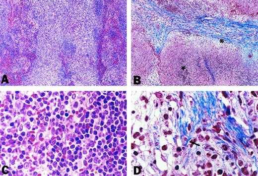 Fig. 5. High-power views of spleen pathology. Spleen sections from FL-overexpressing animals at 2 weeks (A and C) or 6 weeks posttransplantation (B and D) are shown. H&E-stained sections (A and C) at 2 weeks posttransplantation show splenic white pulp expanded with a polymorphous cell population (C) characterized by large, open nuclei with occasional nucleoli. Masson's trichrome-stained sections (B and D) show fibrotic (asterisk) and necrotic (star) change by 6 weeks posttransplantation. At a higher power (D), mature collagen can be seen to envelop individual cells (arrow). (A) and (B) were photographed with a 10× objective, whereas (C) and (D) were photographed with a 100× objective.