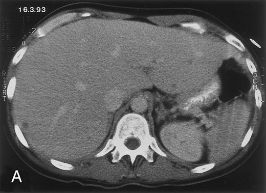 Fig. 1. Radiologic evolution in patient A. (A) Postcontrast abdominal CT scan on March 16, 1993 shows multiple small hypodense areas in all segments of the liver, suggestive of hepatic candidiasis. Seven days previously, the patient had recovered from severe neutropenia after the first cycle of chemotherapy for AML. (B) On April 23, 6 days after the neutrophil count had dropped below 500/μL in the second cycle of chemotherapy, there is no evidence of focal lesions on postcontrast CT scan. (C) On June 18, when neutrophils were normalized for 46 days, CT scan again shows multiple small abscesses. / (D) On August 23, 15 days after the neutrophil count had dropped below 500/μL in the third chemotherapy cycle, focal liver lesions clearly decreased in size and number. (E) On September 30, 35 days after neutrophil recovery, multiple hepatic abscesses are seen (arrowhead). To show maximal extent of lesions the scan shown is at a slightly different level. (F) On June 16, 1994, 230 days after neutrophil recovery, the CT scan has normalized.