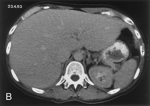 Fig. 1. Radiologic evolution in patient A. (A) Postcontrast abdominal CT scan on March 16, 1993 shows multiple small hypodense areas in all segments of the liver, suggestive of hepatic candidiasis. Seven days previously, the patient had recovered from severe neutropenia after the first cycle of chemotherapy for AML. (B) On April 23, 6 days after the neutrophil count had dropped below 500/μL in the second cycle of chemotherapy, there is no evidence of focal lesions on postcontrast CT scan. (C) On June 18, when neutrophils were normalized for 46 days, CT scan again shows multiple small abscesses. / (D) On August 23, 15 days after the neutrophil count had dropped below 500/μL in the third chemotherapy cycle, focal liver lesions clearly decreased in size and number. (E) On September 30, 35 days after neutrophil recovery, multiple hepatic abscesses are seen (arrowhead). To show maximal extent of lesions the scan shown is at a slightly different level. (F) On June 16, 1994, 230 days after neutrophil recovery, the CT scan has normalized.