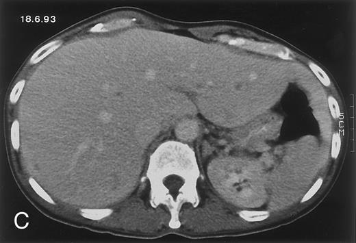 Fig. 1. Radiologic evolution in patient A. (A) Postcontrast abdominal CT scan on March 16, 1993 shows multiple small hypodense areas in all segments of the liver, suggestive of hepatic candidiasis. Seven days previously, the patient had recovered from severe neutropenia after the first cycle of chemotherapy for AML. (B) On April 23, 6 days after the neutrophil count had dropped below 500/μL in the second cycle of chemotherapy, there is no evidence of focal lesions on postcontrast CT scan. (C) On June 18, when neutrophils were normalized for 46 days, CT scan again shows multiple small abscesses. / (D) On August 23, 15 days after the neutrophil count had dropped below 500/μL in the third chemotherapy cycle, focal liver lesions clearly decreased in size and number. (E) On September 30, 35 days after neutrophil recovery, multiple hepatic abscesses are seen (arrowhead). To show maximal extent of lesions the scan shown is at a slightly different level. (F) On June 16, 1994, 230 days after neutrophil recovery, the CT scan has normalized.