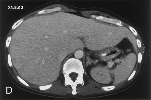 Fig. 1. Radiologic evolution in patient A. (A) Postcontrast abdominal CT scan on March 16, 1993 shows multiple small hypodense areas in all segments of the liver, suggestive of hepatic candidiasis. Seven days previously, the patient had recovered from severe neutropenia after the first cycle of chemotherapy for AML. (B) On April 23, 6 days after the neutrophil count had dropped below 500/μL in the second cycle of chemotherapy, there is no evidence of focal lesions on postcontrast CT scan. (C) On June 18, when neutrophils were normalized for 46 days, CT scan again shows multiple small abscesses. / (D) On August 23, 15 days after the neutrophil count had dropped below 500/μL in the third chemotherapy cycle, focal liver lesions clearly decreased in size and number. (E) On September 30, 35 days after neutrophil recovery, multiple hepatic abscesses are seen (arrowhead). To show maximal extent of lesions the scan shown is at a slightly different level. (F) On June 16, 1994, 230 days after neutrophil recovery, the CT scan has normalized.
