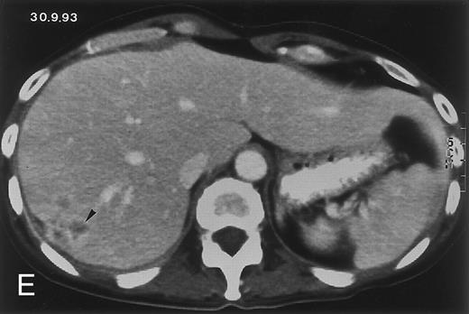 Fig. 1. Radiologic evolution in patient A. (A) Postcontrast abdominal CT scan on March 16, 1993 shows multiple small hypodense areas in all segments of the liver, suggestive of hepatic candidiasis. Seven days previously, the patient had recovered from severe neutropenia after the first cycle of chemotherapy for AML. (B) On April 23, 6 days after the neutrophil count had dropped below 500/μL in the second cycle of chemotherapy, there is no evidence of focal lesions on postcontrast CT scan. (C) On June 18, when neutrophils were normalized for 46 days, CT scan again shows multiple small abscesses. / (D) On August 23, 15 days after the neutrophil count had dropped below 500/μL in the third chemotherapy cycle, focal liver lesions clearly decreased in size and number. (E) On September 30, 35 days after neutrophil recovery, multiple hepatic abscesses are seen (arrowhead). To show maximal extent of lesions the scan shown is at a slightly different level. (F) On June 16, 1994, 230 days after neutrophil recovery, the CT scan has normalized.