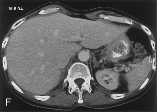 Fig. 1. Radiologic evolution in patient A. (A) Postcontrast abdominal CT scan on March 16, 1993 shows multiple small hypodense areas in all segments of the liver, suggestive of hepatic candidiasis. Seven days previously, the patient had recovered from severe neutropenia after the first cycle of chemotherapy for AML. (B) On April 23, 6 days after the neutrophil count had dropped below 500/μL in the second cycle of chemotherapy, there is no evidence of focal lesions on postcontrast CT scan. (C) On June 18, when neutrophils were normalized for 46 days, CT scan again shows multiple small abscesses. / (D) On August 23, 15 days after the neutrophil count had dropped below 500/μL in the third chemotherapy cycle, focal liver lesions clearly decreased in size and number. (E) On September 30, 35 days after neutrophil recovery, multiple hepatic abscesses are seen (arrowhead). To show maximal extent of lesions the scan shown is at a slightly different level. (F) On June 16, 1994, 230 days after neutrophil recovery, the CT scan has normalized.