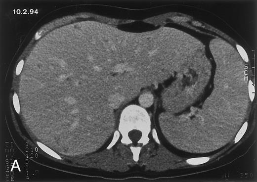 Fig. 2. Radiologic evolution in patient B. (A) Postcontrast abdominal CT scan on February 10, 1994 shows multiple small hypodense areas in all segments of the liver suggestive of hepatic candidiasis. Twenty-four days previously, the patient had recovered from severe neutropenia after the second cycle of chemotherapy for ALL. (B) On May 4, 16 days after the neutrophil count had dropped below 500/μL in the third chemotherapy cycle, there is clear improvement of the radiologic findings, with only a few hypodense areas in the liver. / (C) On June 6, 31 days after normalization of neutrophils, CT again shows multiple lesions in the liver (arrowheads) with a different presentation: the small lesions show strong peripheral enhancement. (D) On September 2, 129 days after neutrophil recovery, all hepatic lesions have completely resolved.