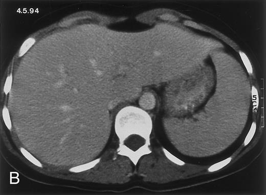 Fig. 2. Radiologic evolution in patient B. (A) Postcontrast abdominal CT scan on February 10, 1994 shows multiple small hypodense areas in all segments of the liver suggestive of hepatic candidiasis. Twenty-four days previously, the patient had recovered from severe neutropenia after the second cycle of chemotherapy for ALL. (B) On May 4, 16 days after the neutrophil count had dropped below 500/μL in the third chemotherapy cycle, there is clear improvement of the radiologic findings, with only a few hypodense areas in the liver. / (C) On June 6, 31 days after normalization of neutrophils, CT again shows multiple lesions in the liver (arrowheads) with a different presentation: the small lesions show strong peripheral enhancement. (D) On September 2, 129 days after neutrophil recovery, all hepatic lesions have completely resolved.