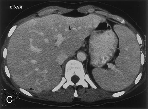 Fig. 2. Radiologic evolution in patient B. (A) Postcontrast abdominal CT scan on February 10, 1994 shows multiple small hypodense areas in all segments of the liver suggestive of hepatic candidiasis. Twenty-four days previously, the patient had recovered from severe neutropenia after the second cycle of chemotherapy for ALL. (B) On May 4, 16 days after the neutrophil count had dropped below 500/μL in the third chemotherapy cycle, there is clear improvement of the radiologic findings, with only a few hypodense areas in the liver. / (C) On June 6, 31 days after normalization of neutrophils, CT again shows multiple lesions in the liver (arrowheads) with a different presentation: the small lesions show strong peripheral enhancement. (D) On September 2, 129 days after neutrophil recovery, all hepatic lesions have completely resolved.