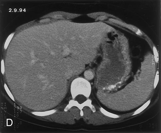 Fig. 2. Radiologic evolution in patient B. (A) Postcontrast abdominal CT scan on February 10, 1994 shows multiple small hypodense areas in all segments of the liver suggestive of hepatic candidiasis. Twenty-four days previously, the patient had recovered from severe neutropenia after the second cycle of chemotherapy for ALL. (B) On May 4, 16 days after the neutrophil count had dropped below 500/μL in the third chemotherapy cycle, there is clear improvement of the radiologic findings, with only a few hypodense areas in the liver. / (C) On June 6, 31 days after normalization of neutrophils, CT again shows multiple lesions in the liver (arrowheads) with a different presentation: the small lesions show strong peripheral enhancement. (D) On September 2, 129 days after neutrophil recovery, all hepatic lesions have completely resolved.