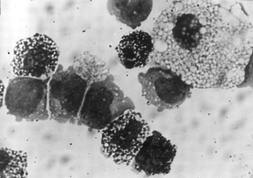 Fig. 3. Photomicrograph of a portion of the May-Grünwald Giemsa-stained smear of a mixed NK cell colony showing a macrophage, mast cells, and 5 lymphoid cells.