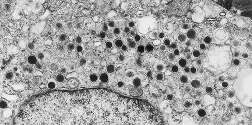 Metastatic carcinoid tumor of hindgut origin. A 50-year-old, asymptomatic woman with a retroperitoneal mass, found on routine physical examination, underwent surgery. Only formaldehyde-fixed material was available for ultrastructural studies. Despite poor preservation of subcellular details, tumor cells that were filled with round, electron-dense granules of the type found in hindgut carcinoid tumors were observed. Within 2 months of this surgery, a small primary rectal carcinoid tumor was discovered by endoscopy. Original magnification × 25,000. (Courtesy of Ann M. Dvorak, MD, Department of Pathology, Beth Israel Deaconess Medical Center, 330 Brookline Ave, Boston, MA 02215.)