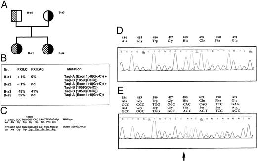 Fig. 2. Pedigree of family B-a with the Taq I-A and Taq I-B alleles associated with the mutations exon 1: −8 (g → c) and exon 12: 10590 (Del C), respectively. Patients B-a1, B-a3, and B-a5 did not show any strong thrombotic symptoms. Patient B-a2 suffered from a superficial thrombophelitis during her pregnancy. (A) Pedigree and sequence of the single basepair deletion. Solid symbols, carriers of the Taq I-A allele/exon 1:−8 (g → c); hatched symbols, carriers of the Taq I-B allele/exon 12: 10590(Del C). (B) Coagulation parameters. (C) Comparison of wild-type and mutated sequences. (D) Fluorescence sequence analysis of wild-type exon 12 PCR products. (E) Analysis of an individual B-a1. Mutated and wild-type exon 12 sequences are superimposed. The arrow indicates the deletion of a single base at nucleotide position 10590.