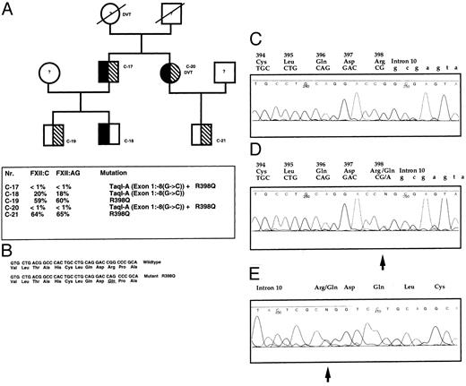 Fig. 4. (A) Pedigree of case C-17. Mutation R398Q (hatched symbols) and Taq I-A associated with exon 1: −8 (g → c) (solid symbols). (A) Pedigree of case C-17 with a CRM-negative phenotype. For all individuals C-17 through C-21, the protein C, protein S, AT III, and plasminogen levels were in the normal range, and the factor V-Leiden mutation was excluded.39 Patient C-20 suffered from recurrent deep vein thrombosis and pulmonary embolism, and C-17 had a stroke and peripheral vascular disease. (B) Clotting parameters and genotypes. (C) Automatic sequence analysis of wild-type exon 10 (forward). (D) Automatic sequence analysis of a heterozygous patient C-17. Mutated exon 10: R398Q(9998 G → A) and wild-type sequence. (E) Reverse sequence of patient C-17. The arrow indicates the mutation.