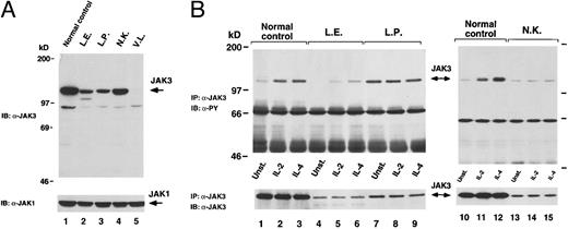 Fig. 3. (A) Analysis of JAK3 expression. Lysates of BCLs obtained from normal control subject (lane 1) or JAK3-deficient patients cells (lanes 2 through 5) were subjected to SDS-PAGE and then immunoblotted (IB) with JAK3 antiserum (a-JAK3, top). The membrane was then stripped and reblotted with JAK1 antiserum (a-JAK1, bottom) to verify equal loading. (B) Analysis of JAK3 phosphorylation. Control (lanes 1 through 3 and 10 through 12) and JAK3-SCID patients cells (lanes 4 through 9 and 13 through 15) were stimulated with the indicated cytokine for 15 minutes, lysed, and immunoprecipitated (IP) with a-JAK3. Complexes were detected by immunoblotting (IB) with monoclonal antibody specific for phosphorylated tyrosine residues (a-PY, top). The membrane was then stripped and the presence of JAK3 in the immunoprecipitates was verified by reblotting with a-JAK3 (bottom).