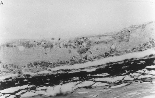 Fig. 7. Histologic ocular changes observed in (LEW × BN) F1 rats 35 days after S Ag immunization. (A) In the control rat injected only with S Ag, there is destruction of the photoreceptor cell layer and most of the bipolar cell layer with the presence of inflammatory cells. (B) In a rat treated with IVIgM, there is complete integrity of the retinal structure (Hematoxylin eosin, original magnification × 270).