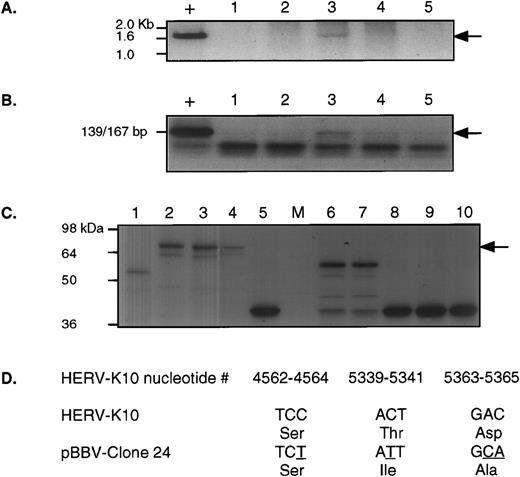 Fig. 5. Comprehensive analysis from patient UPN09. (A) shows the 1.7-kb RT-PCR product obtained using nested PCR, first with RT5out/RT3out and then with RT5Eco/RT3Not. “+” indicates the positive control for this reaction, a clone of HERV-K10. Lanes 1, 2, 3, 4, and 5 are selected fractions from the bottom to top of a sucrose gradient preparation from this patient. The arrow indicates the position of the positive signal. Lane 3 is positive. (B) shows the same fractions analyzed for RT activity. “+” indicates the positive control for this reaction, ie, 0.002 U of MoMLV-RT. Again, lane 3 is positive and the arrow indicates the position of the positive signal. (C) shows SDS-PAGE products detected by fluorography from in vitro translation of several independent RT-PCR clones in pBBV. Lanes 1, 2, 5, and 6 through are independent clones obtained from the RT-PCR product shown in (A), lane 3 above. Lanes 3 and 4 are two different clones of HERV-K10 included for comparison. As can be seen, only lane 2 expresses a protein of apparently full length, which is indicated by the arrow. (D) shows the nucleotide sequence and the deduced amino acid sequence of this clone (pBBV-24) at only those positions that differ from the HERV-K10 prototypic sequence between nucleotides 3950 and 5651 (the RT and RNaseH domains).