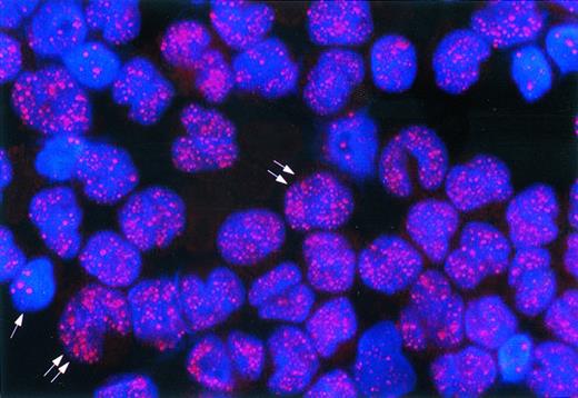 Fig. 2. APL, microgranular variant (M3V). The nuclei of APL cells (double arrows) contain many tiny dots (microgranular pattern). The single arrow points to a residual normal hematopoietic cell showing the speckled positivity of wild-type PML. Indirect immunofluorescence technique with rhodamine-labeled antibody; nuclear DAPI counterstain; original magnification × 1,000.