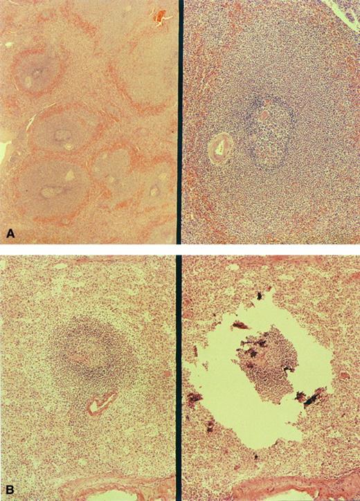 Fig. 1. Morphology of the spleen involved by MALT lymphoma. (A) The markedly enlarged marginal zones in case no. 1 (left, low-power view; right, high-power view). (B) marginal zone in case no. 4; right, microdissection of the same marginal zone cell population.