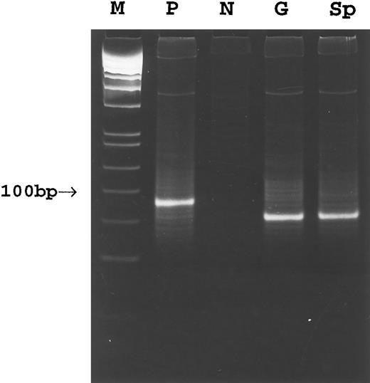 Fig. 3. PCR amplification of the Fr3-JH region of the rearranged Ig gene in case 3. M, molecular weight marker; P, positive control; N, negative control; G, gastric tumor; Sp, spleen.