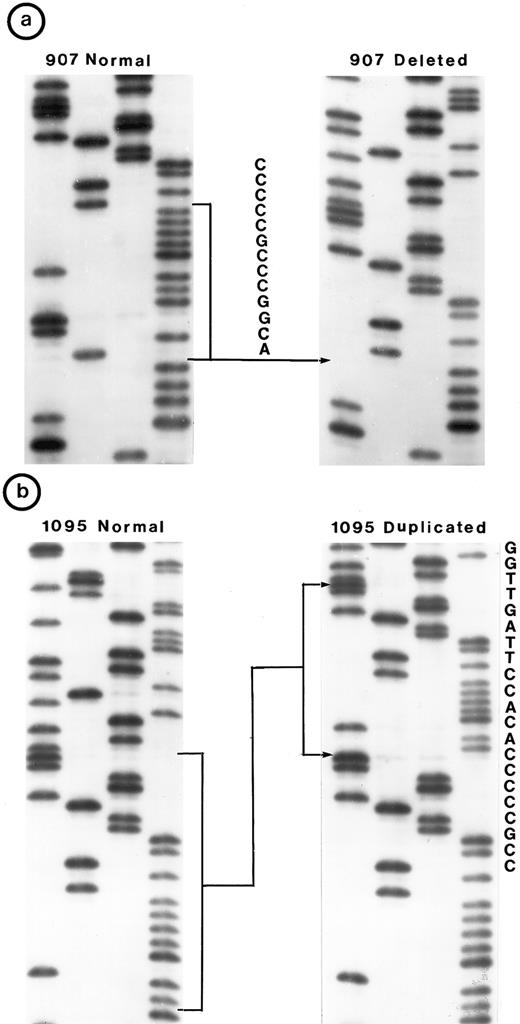 Fig. 2. Nucleotide sequence of representative mutant P53 alleles. DNA from tumors scored positive on PCR-SSCP analysis were further characterized by nucleotide sequencing of both DNA strands. (a and b) Structural changes in exon 5. PCR product from these tumors was cloned into a TA-vector from which normal and mutant alleles were isolated and sequenced. Tumor no. 907 had a deletion and no. 1095 had a duplication. / (c, d, e, and f) Representative point mutations in exon 6. (g, h, i, and j) Representative point mutations in exon 7. PCR-amplified DNA from these tumors was sequenced directly. Note that both homologs of chromosome 17 were cytogenetically normal in nos. 323, 1095, and 1866; 1 copy of 17p was lost in nos. 459, 840, and 905; status of chromosome 17 was not known in nos. 629 and 2303.