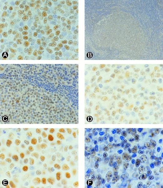 Fig. 3. Representative examples of p53 expression in B-NHL. Sections from formlin-fixed tissues were incubated with DAKO N1581 p53 antibody. Tumor cells (nuclei) expressing p53 were stained brown. (A) SLL, (B) FSCC, (C) a portion of B as viewed under a higher magnification, (D) FMx, (E) DMx, (F) DCL.