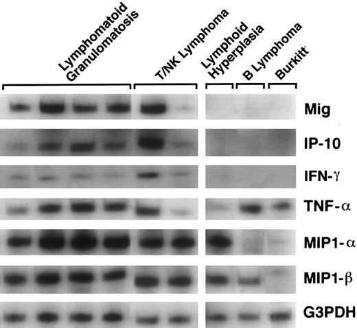 Fig. 1. Patterns of cytokine and chemokine mRNAs in lymphoproliferative disease tissues shown by RT-PCR analysis. Total cellular RNA, extracted from paraffin-embedded tissues representative of lymphomatoid granulomatosis, nasal T/NK-cell lymphoma, lymphoid hyperplasia, malignant B-cell lymphoma, and Burkitt's lymphoma, was subjected to RT-PCR analysis using appropriately designed primers.