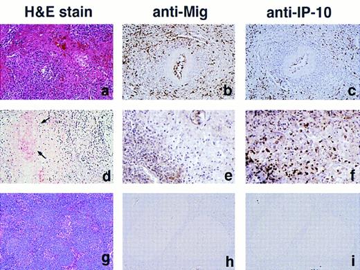 Fig. 3. Immunohistochemical analysis of Mig and IP-10 in lymphoproliferative disease tissues representative of LYG, nasal T/NK-cell lymphoma, and lymphoid hyperplasia. (A, B, and C) LYG, lung; (D, E, and F ) nasal T/NK-cell lymphoma, nasal septum (D, arrows indicate vessel with fibrinoid necrosis); (G, H, and I) reactive lymphoid hyperplasia, lymph node. Paraffin-embedded tissue sections were stained with Hematoxylin and Eosin (A, D, and G), with an anti-Mig heteroantiserum (B, E, and H), and with an anti–IP-10 heteroantiserum (C, F, and I). Primary antibodies were detected with biotinylated antimouse/rabbit IgG followed by streptavidin-peroxidase complexes. (Original magnification × 40.)