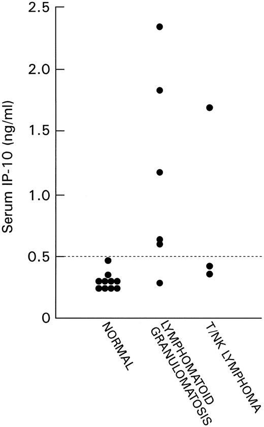 Fig. 4. IP-10 content in serum samples of normal patients and patients with LYG and nasal T/NK-cell lymphoma detected by sandwich ELISA. The lowest limit of detection was 10 pg/mL.