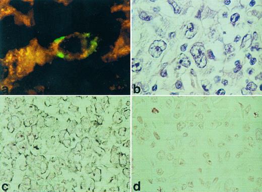 Fig. 1. RISH analysis of HOXC5 on a nodal (a) and cutaneous (c) ALCL. A double staining for HOXC5 using RISH (green) and CD30 using immunohistochemistry (red) of a nodal ALCL (case no. 36) is shown in (a) and a hematoxlin and eosin staining of this lymphoma is shown in (b). Positive signals are shown as black DAB/Ni precipitates in (c), and sense control is shown in (d).