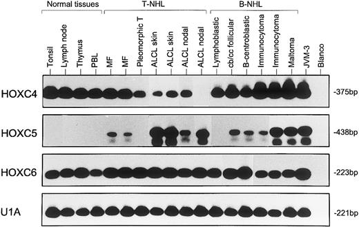 Fig. 4. Representative results from two to five independent experiments of RT-PCR analysis showing expression of HOXC4, HOXC5, and HOXC6 in normal lymphoid tissues (lanes 1 through 4), T-NHL (lanes 5 through 11), and B-NHL (lanes 12 through 17). MF samples correspond with cases no. 1 and 4, pleomorphic T-cell lymphomas correspond with case no. 12, and ALCLs correspond with cases no. 39, 26, 30, and 32 of Table 1. B-NHLs correspond with cases no. 5, 19, 22, 35, 32, and 41 of Table 2. Controls included B-cell line JVM-3 and water (blanco). The snRNP gene U1A was used as control for the RNA quality and quantity. Blots hybridized with specific oligomer probes were exposed for 20 hours. Note that the immunocytoma in lane 16 (case no. 32), which is positive for HOXC5 expression by RISH analysis, shows a stronger signal for HOXC5 by RT-PCR than the RISH HOXC5-negative immunocytoma in lane 15 (case no. 35).