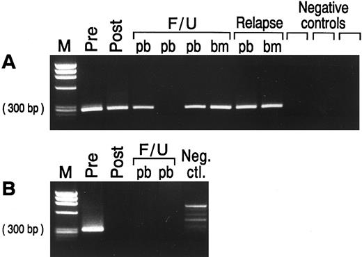 Fig. 4. EtBr stained agarose gel with semi-nested PCR products from prelysis and postlysis BM harvest and from peripheral blood (pb) and/or bone marrow (bm) samples at time of BMT, post-BMT follow-up (F/U), and relapse in patients with MCL. (A) Patient no. 1705 samples tested with the relevant ASO primer. The ASO primer specific for patient no. 1705 did not amplify three different MCL patients used as negative controls. (B) Patient no. 1846 samples tested with the BCL-1/IgH primers. No clonal product was seen in the normal donor PBL used as negative control. Negative control, neg. ctl.; M, molecular weight marker.