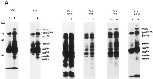 Fig. 3. Induction of tyrosine phosphorylation through VLA/β1-stimulation. (A) Induction of several proteins' tyrosine phosphorylation in peripheral lymphocytes from two normal controls (C 1 and 2) and 4 patients (PN 1, 2, 3, and 4) 8 weeks to 2.5 years after allo-BMT. Monocyte-depleted lymphocytes were incubated on plates coated using rabbit antimouse IgG with (+) or without (−) 4B4 (5 μg/mL) for 30 minutes, and then lysed. Whole cell lysate (50 μg/lane) was immediately subjected to Western blotting with the anti-phosphotyrosine MoAb. Autoradiography was carried out for 14 to 18 hours. Normal control samples were analyzed at the same time in each experiment, which constantly demonstrated similar tyrosine phosphorylation pattern to Ct1 and Ct2 (data not shown). Representative results at each stage after allo-BMT from different membranes are shown. (B) Whole thymocytes and immunodepleted thymocytes using anti-CD4 (19Thy) plus anti-CD8 (21Thy). Anti-CD45RA (2H4) or anti-CD45RO (UCHL1) antibody were incubated on plates coated with rabbit antimouse IgG (RbαM) or rabbit antimouse IgG plus anti-CD29 antibody (4B4; 5 μg/mL) for 30 minutes, lysed, and detected by anti-pTyr blot by the same method as above.