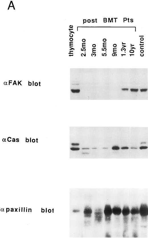 Fig. 4. Endogenous expression of pp125FAK, Cas-L, paxillin, Lck, and vinculin in the whole extracts of thymocytes, post-BMT patients' and healthy volunteers' lymphocytes. (A) Whole thymocytes and peripheral T lymphocytes from post-BMT patients or a normal control (50 μg/lane) were analyzed using anti-FAK MoAb. The same membrane was rehybridized with anti-Cas MoAb followed by anti-paxillin MoAb. (B) Immunodepleted cell population from normal thymocytes using anti-CD3 (OKT3) plus anti-CD4 (19Thy) plus anti-CD8 (21Thy) or anti-CD4 plus anti-CD8 MoAbs, whole thymocytes, and peripheral T lymphocytes from post-BMT patients or normal controls were lysed. Each cell lysate (50 μg/lane) was subjected to Western blotting with anti-Lck MoAb followed by anti-vinculin MoAb.